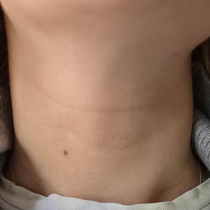 Neck after using Petitfee Gold Hydrogel Neck Mask