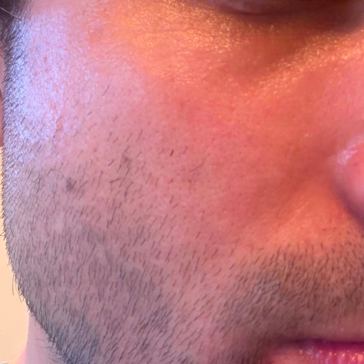 Skin after using Medicube EGF NAD Firming Serum