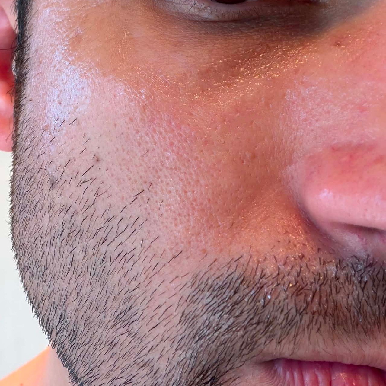 Skin before using Medicube EGF NAD Firming Serum