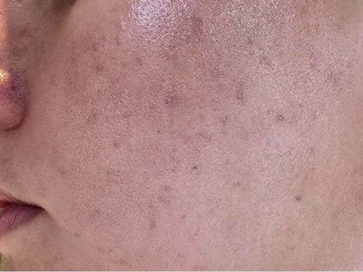 Close up of cheeks showing remaining dark spots left over from acne outbreaks