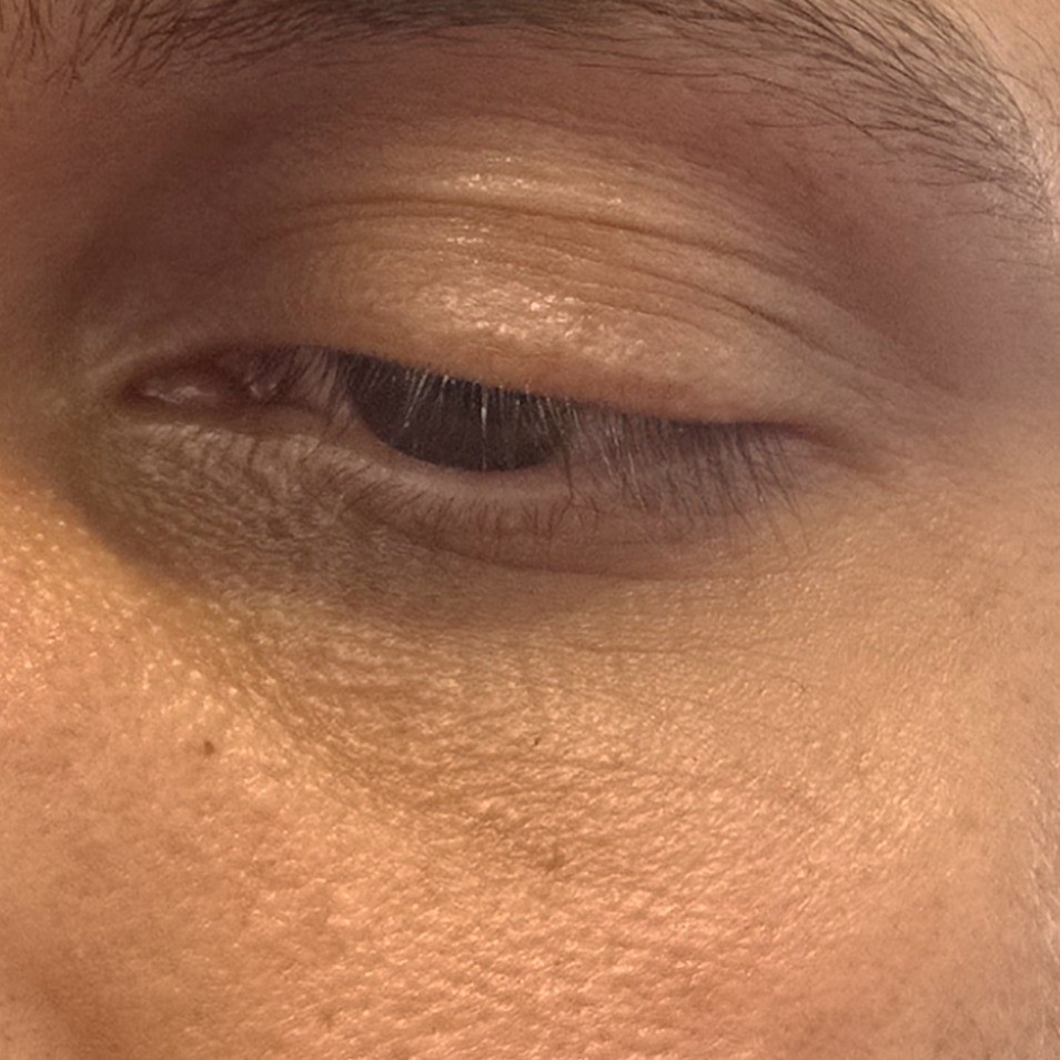 Eye taken before Heveblue device use