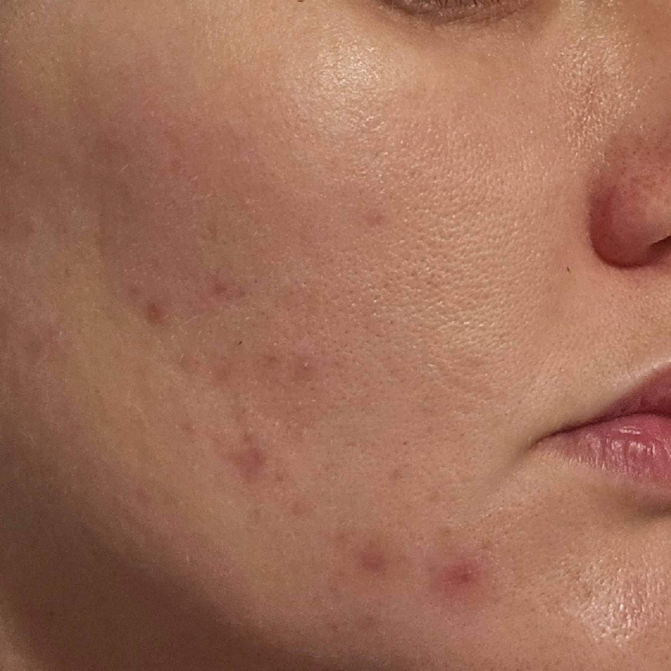 Face before using Medicube Hyaluronic Ceramide Jelly Cream
