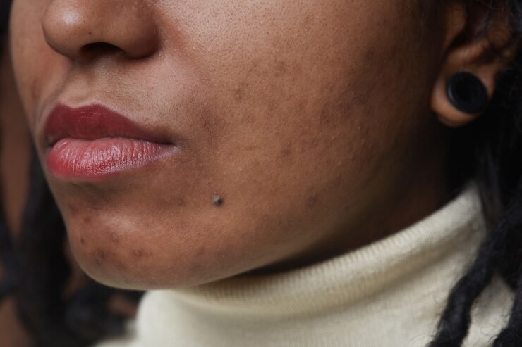 Close up young woman's jaw showing small dark spots