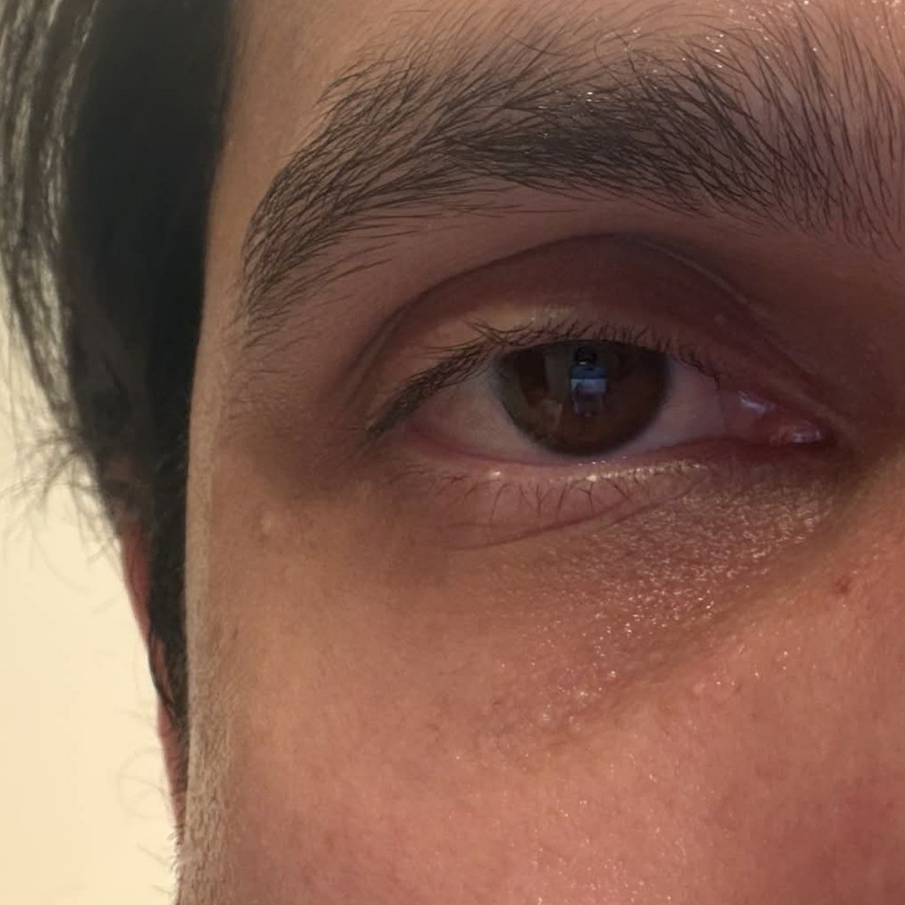 Eye Before Using Medicube Kojic Acid Eye Gel Serum