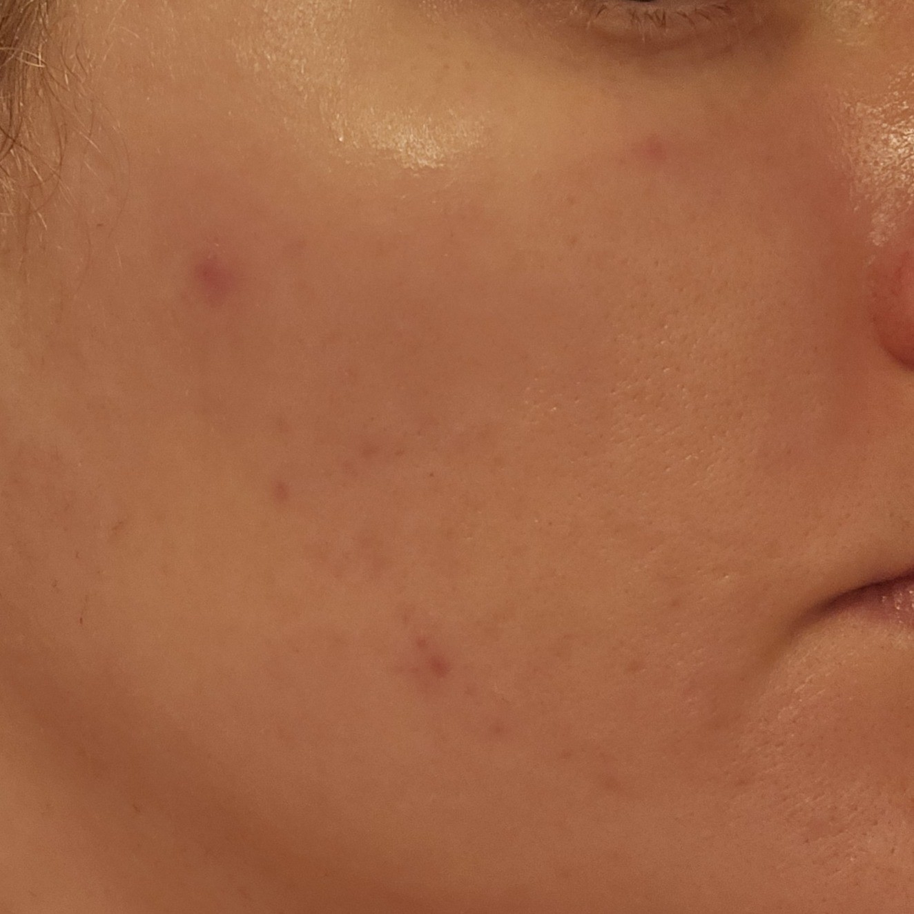 Cheek after Dr Melaxin TXA-Astaxanthin Overnight Wrapping Mask