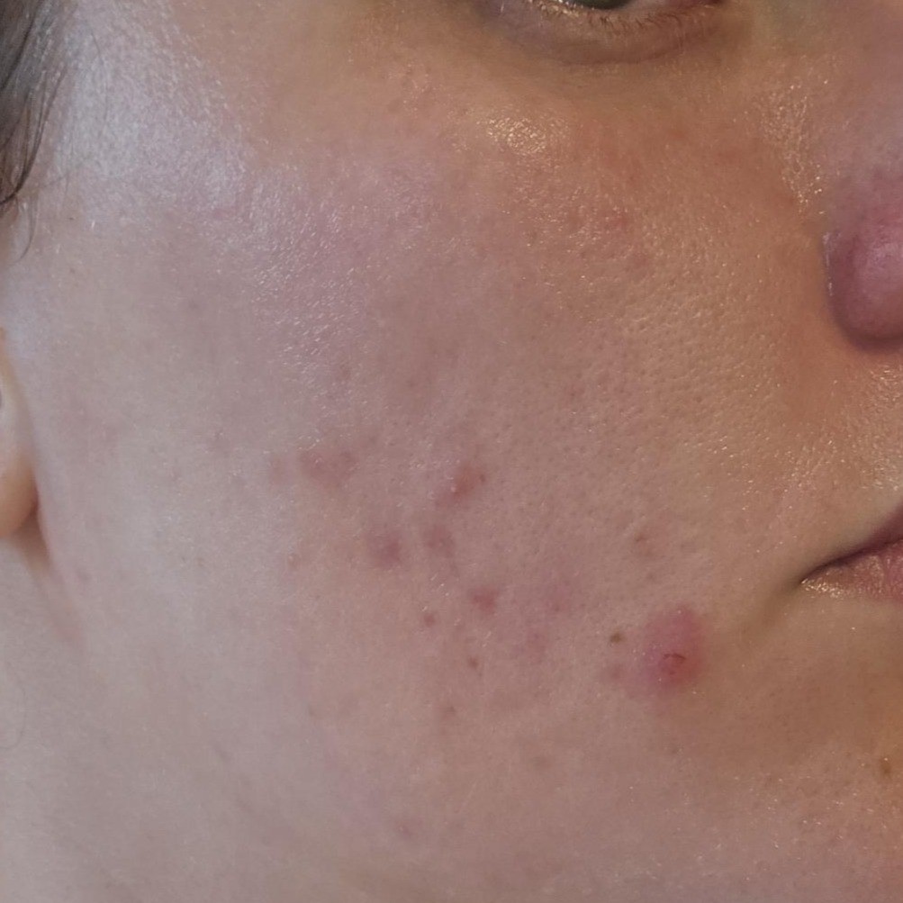 Skin Before using Abib Bright Force Serum