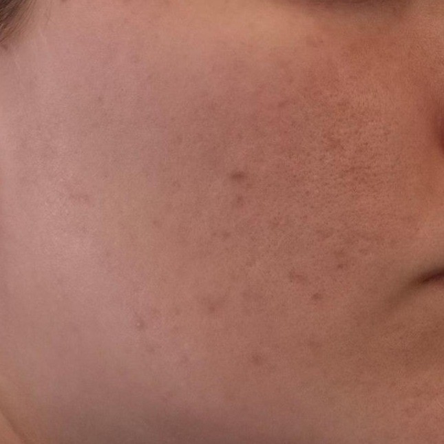 Face close-up after using Isntree Green Tea Fresh Emulsion