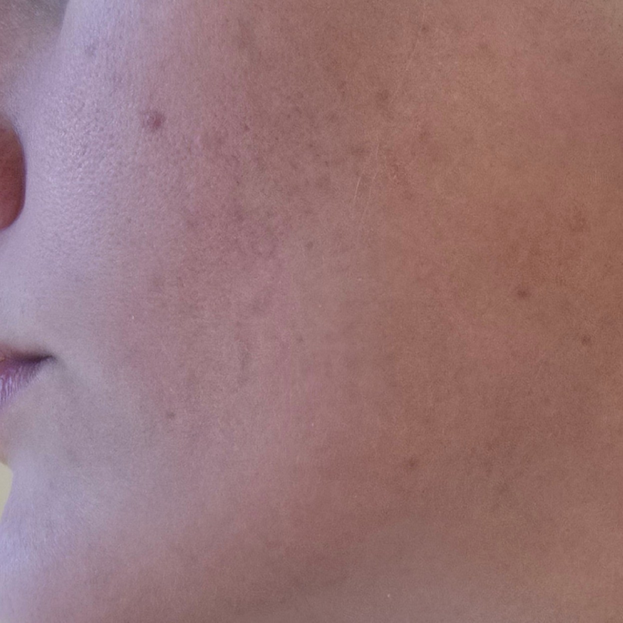 Skin before using Medicube Kojic Acid Toner