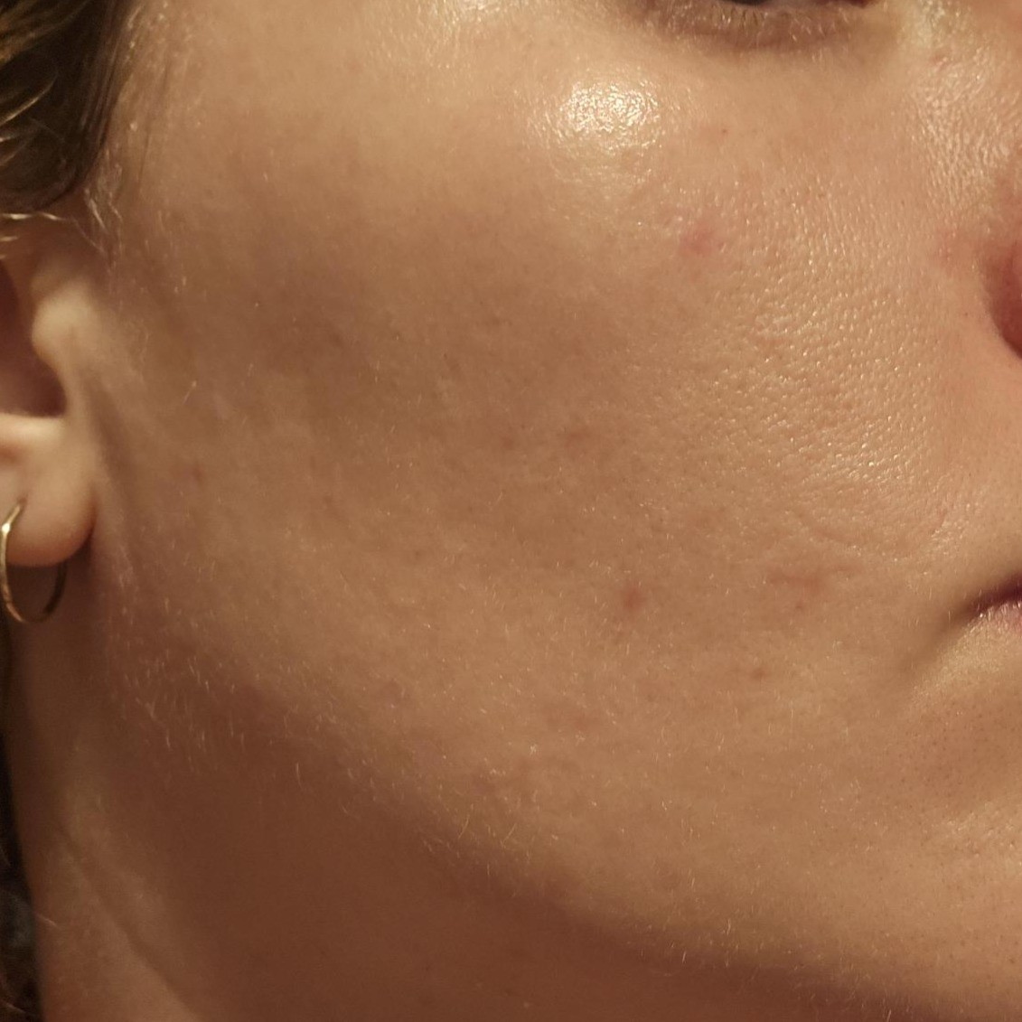 Close Up Cheek After Using Dr Jart+ Teatreement Cleanser