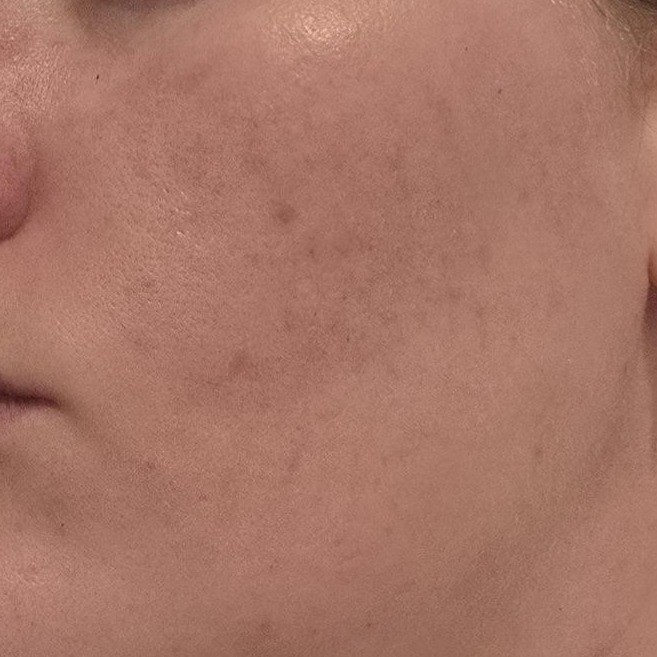 Before Celimax Ji Woo Gae Cica BHA Blemish Toner Pad Use