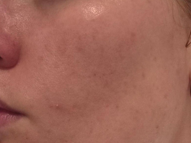 Close up of cheek showing softer dark spots, showing the lifting effect of vitamin C