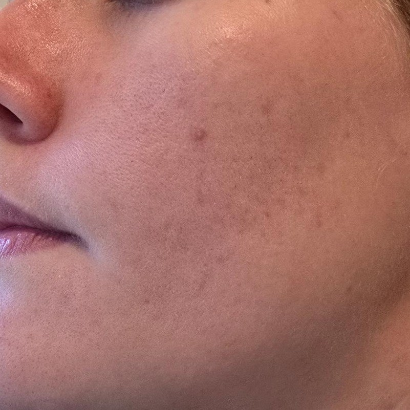 Warmer skin tone and more relieved red spots - close up of cheek