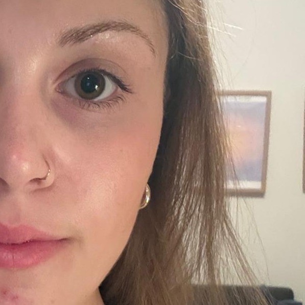 Skin before using Mary&May Collagen Peptide Vital mask