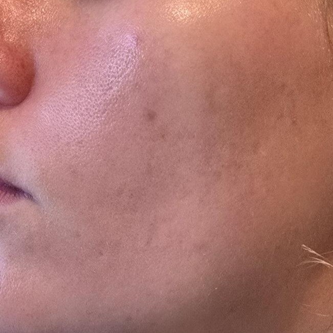 Skin after using Medicube PDRN Pink Peptide Serum (showing clearer skin and reduced acne spots)