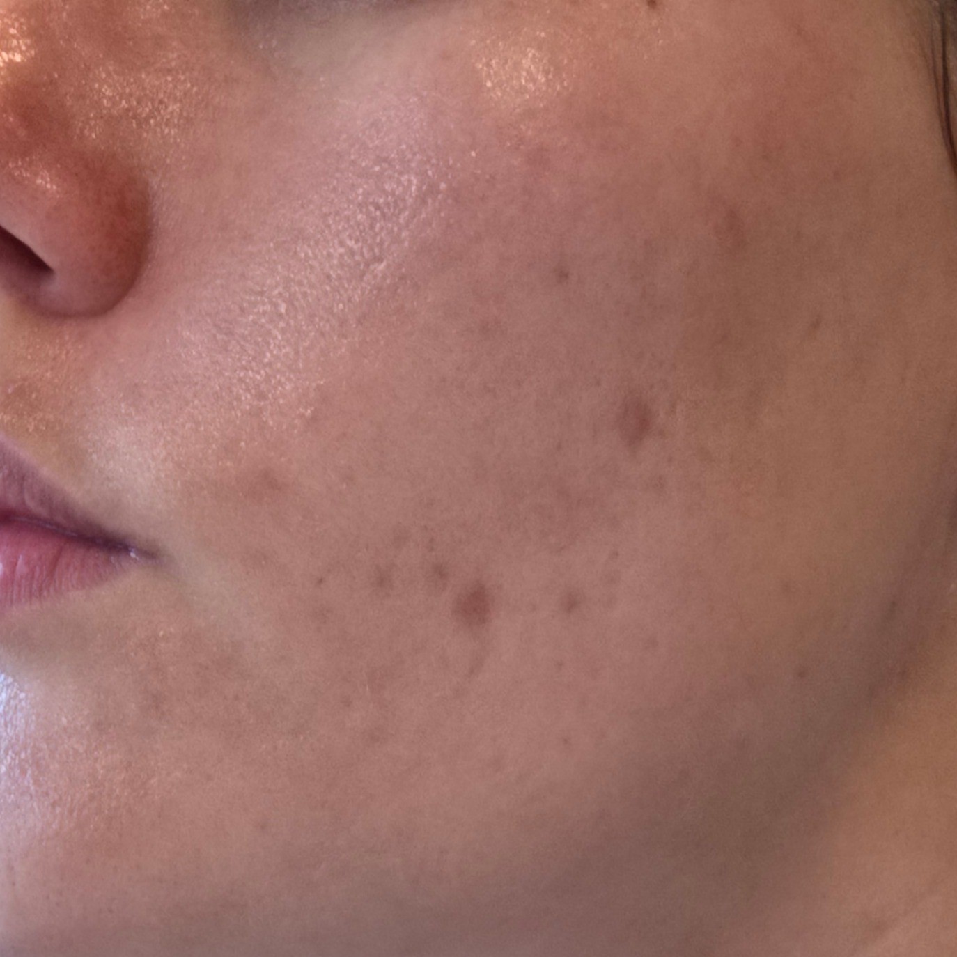 Skin before using Medicube Azelaic Acid Exosome Serum 2000