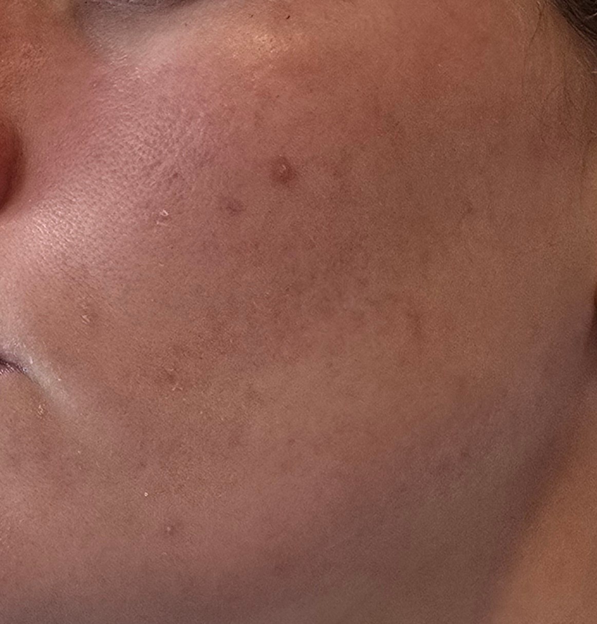 Face before using Anua Azelaic Acid 10 Hyaluron Soothing Serum